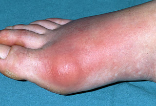 Acute Gouty Arthritis