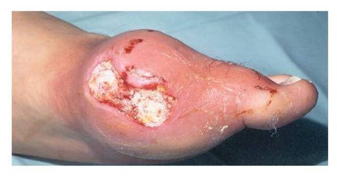 Chronic Tophaceous Gout or Polyarticluar Gout