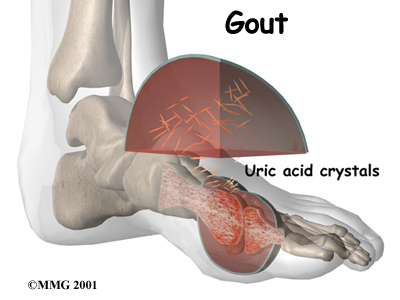 The King's Disease - CURSED GOUT