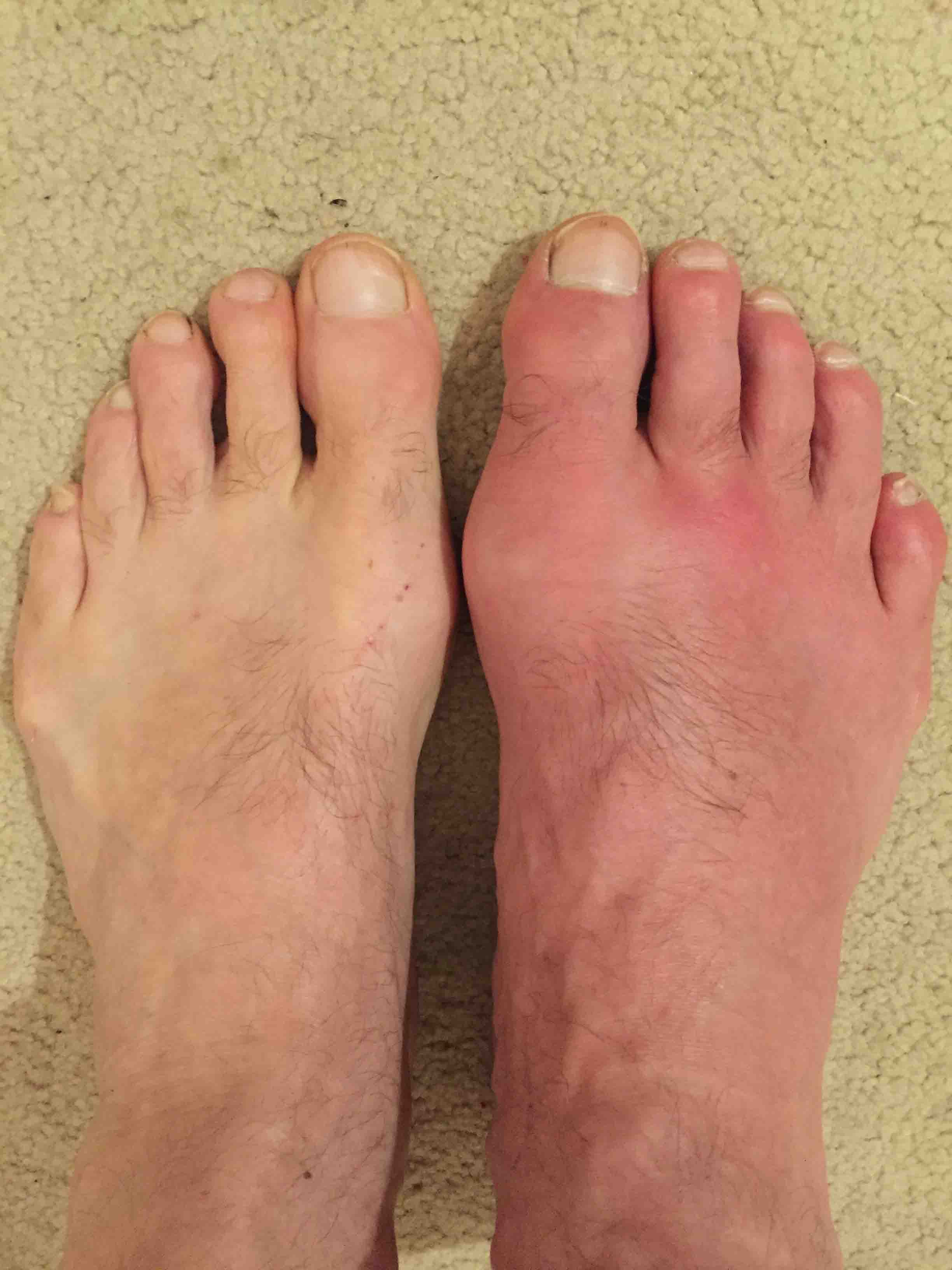 Pictures of Gout and Tophaceous Gout