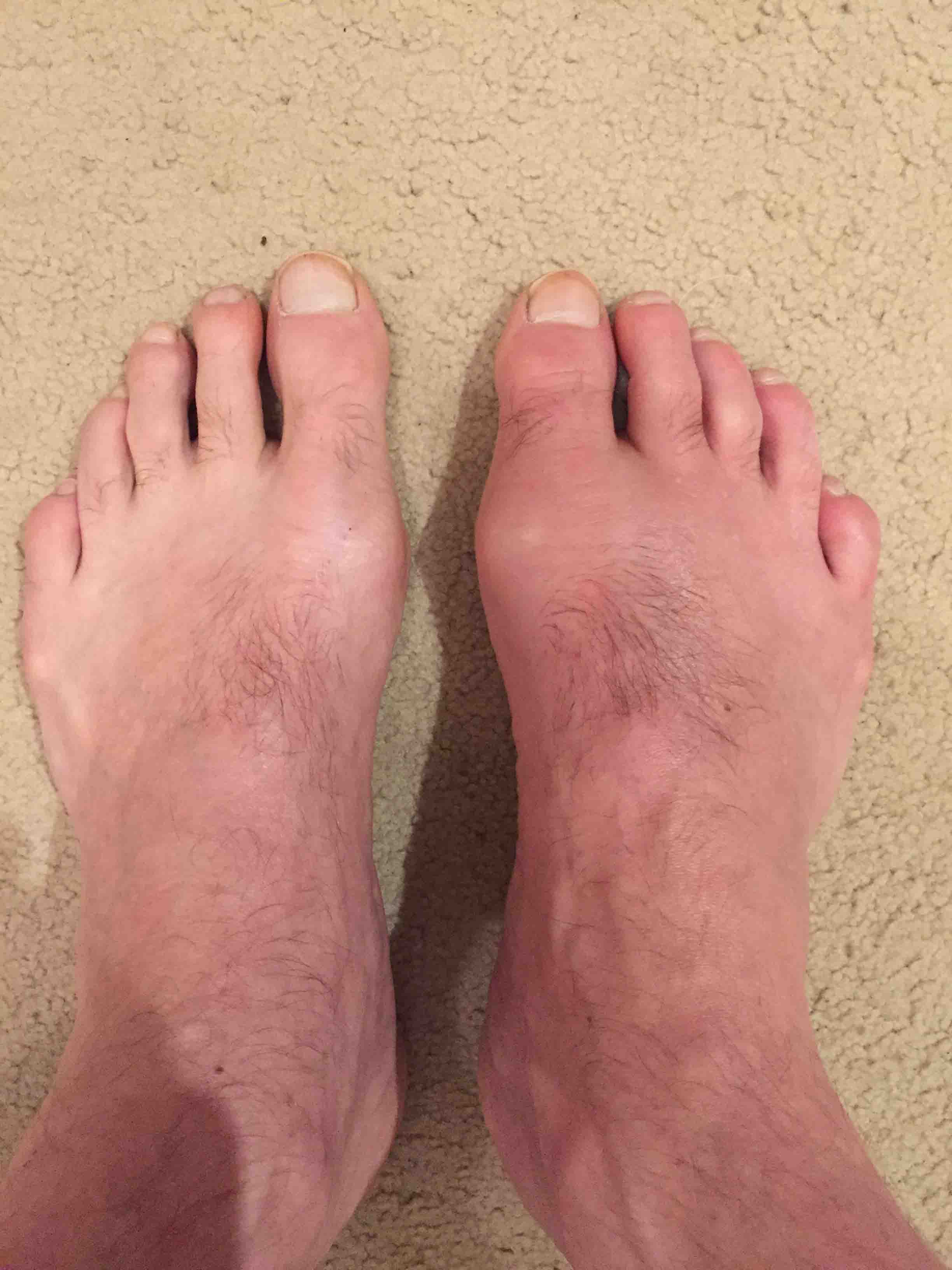 gout in foot pictures