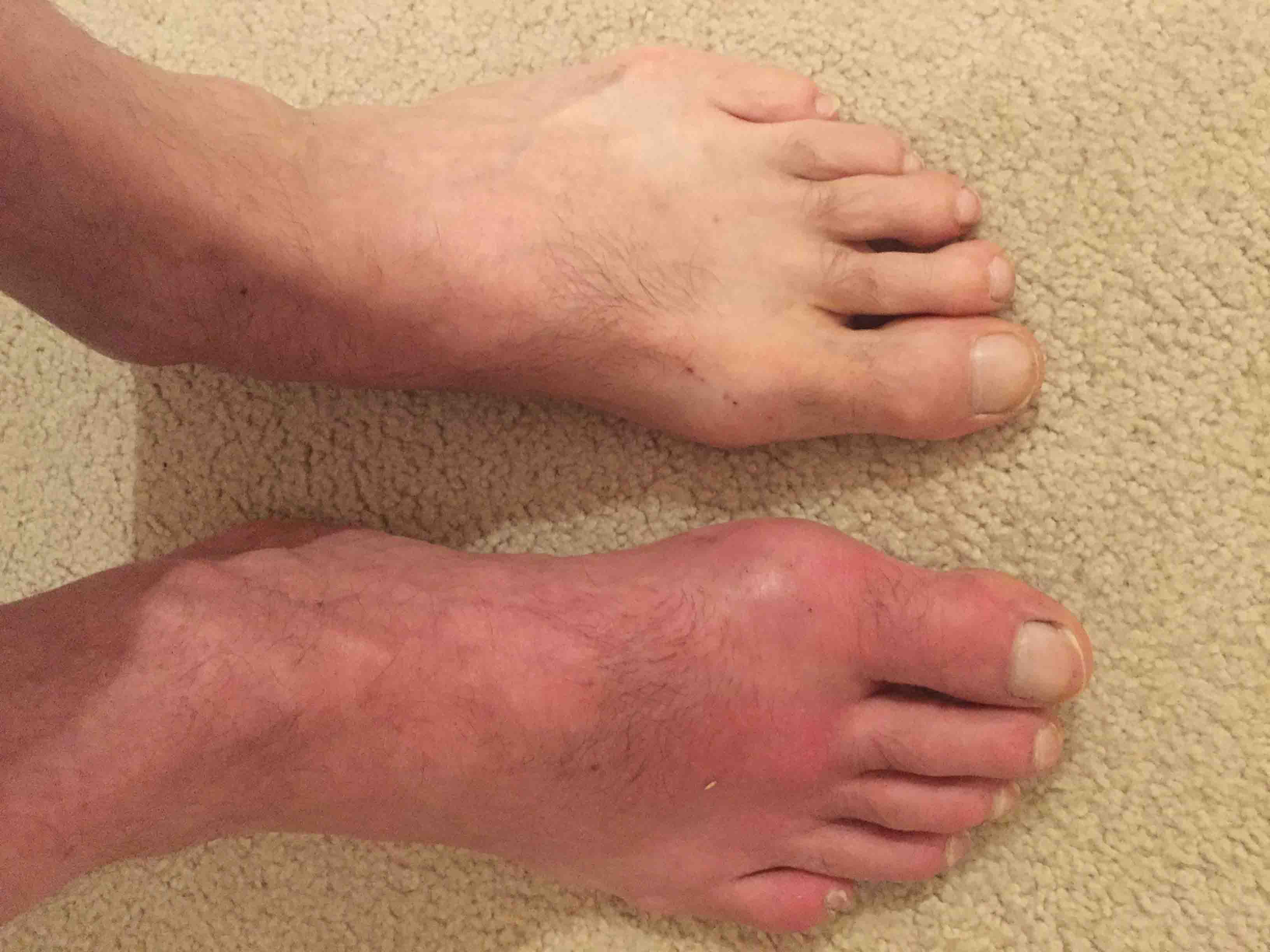 gout in foot pictures