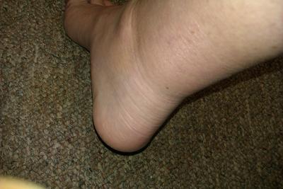 Gout Ankle