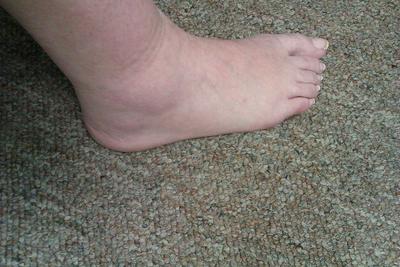 Gout Foot