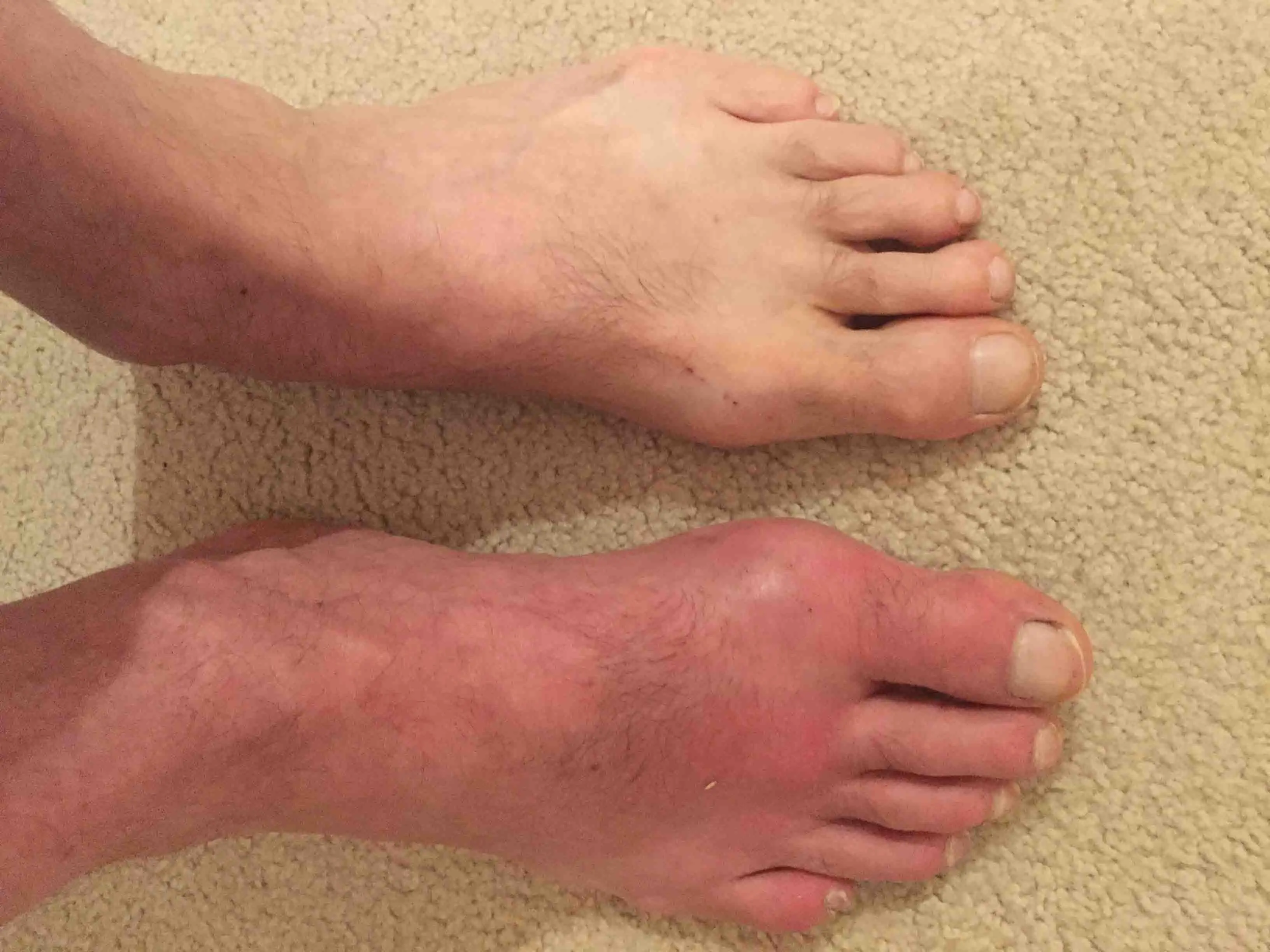 Pictures Of Gout 86